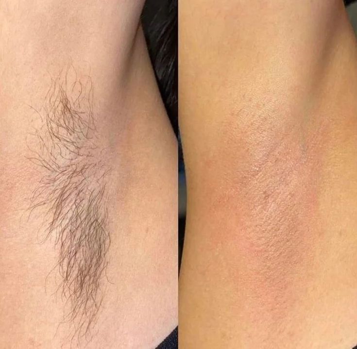 Hot Wax Hair Removal - Gentle & Thorough Treatment
